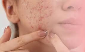 عادات يومية سبب في ظهور البثور والتجاعيد